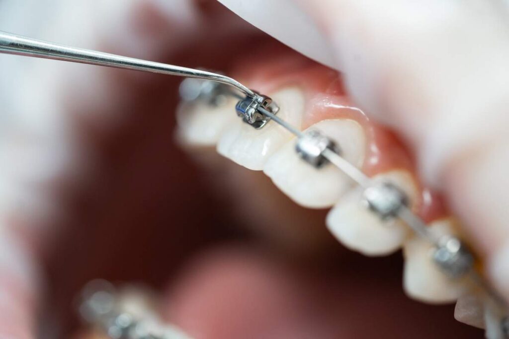 Teenager smiling while brushing traditional braces in a bright bathroom with an orthodontic care kit nearby